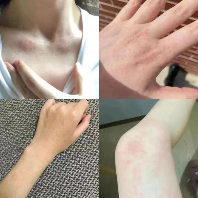 湿疹体质有救了!这款没有激素的湿疹膏安全高效断痒无激素不刺激一抹见效告别反复！(图3)