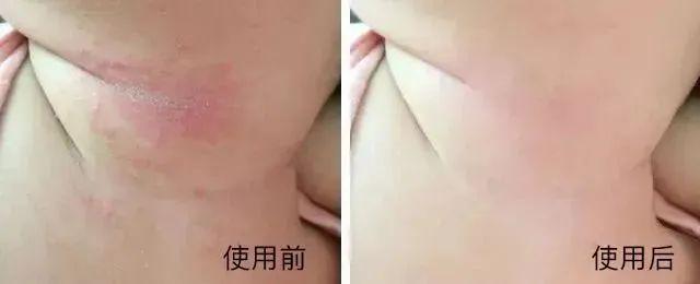 湿疹体质有救了!这款没有激素的湿疹膏安全高效断痒无激素不刺激一抹见效告别反复！(图6)