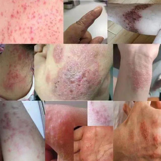 湿疹体质有救了!这款没有激素的湿疹膏安全高效断痒无激素不刺激一抹见效告别反复！(图10)