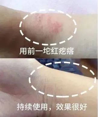 湿疹体质有救了!这款没有激素的湿疹膏安全高效断痒无激素不刺激一抹见效告别反复！(图25)