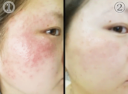 湿疹体质有救了!这款没有激素的湿疹膏安全高效断痒无激素不刺激一抹见效告别反复！(图28)