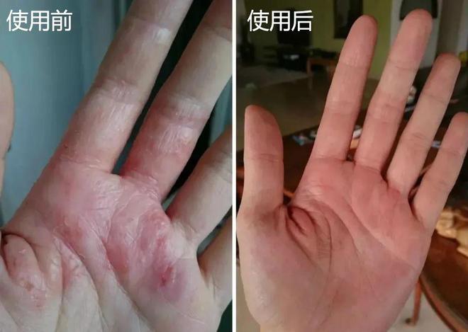 湿疹体质有救了!这款没有激素的湿疹膏安全高效断痒无激素不刺激一抹见效告别反复！(图29)